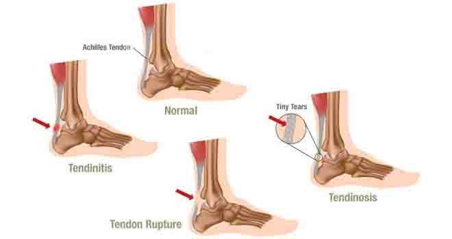 Achilles Tendon Rupture Repair