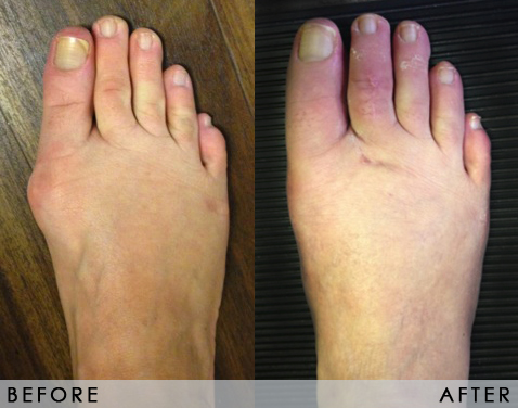 Bunion Correction Before After