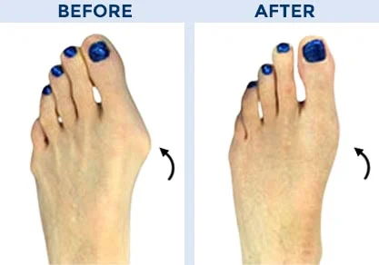 Ankle Surgery Before After